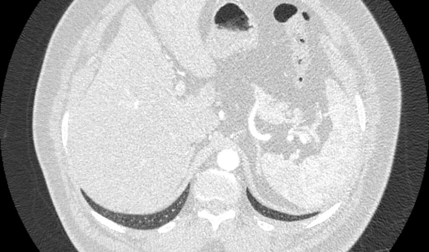 Acute pulmonary embolism with pulmonary infarcts (Radiopaedia 77688-89908 Axial lung window 138).jpg