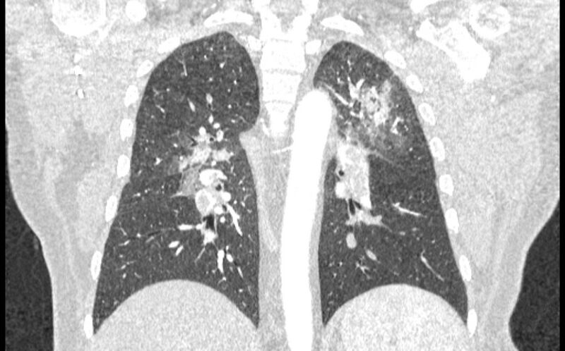 File:Acute pulmonary embolism with pulmonary infarcts (Radiopaedia 77688-89908 Coronal lung window 65).jpg