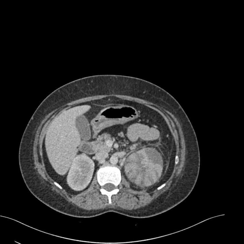 Acute pyelonephritis with renal vein thrombosis (Radiopaedia 58020-65053 Axial renal parenchymal phase 42).jpg