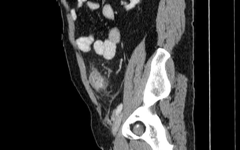 File:Acute sigmoid colon diverticulitis (Radiopaedia 55507-61976 Sagittal C+ portal venous phase 72).jpg