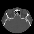 Acute sinusitis (Radiopaedia 23161-23215 Axial bone window 57).jpg