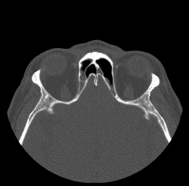 File:Acute sinusitis (Radiopaedia 23161-23215 Axial bone window 57).jpg