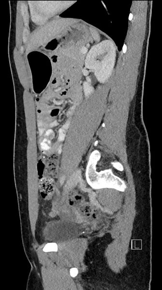 File:Acute uncomplicated appendicitis (Radiopaedia 61374-69304 Sagittal C+ portal venous phase 37).jpg