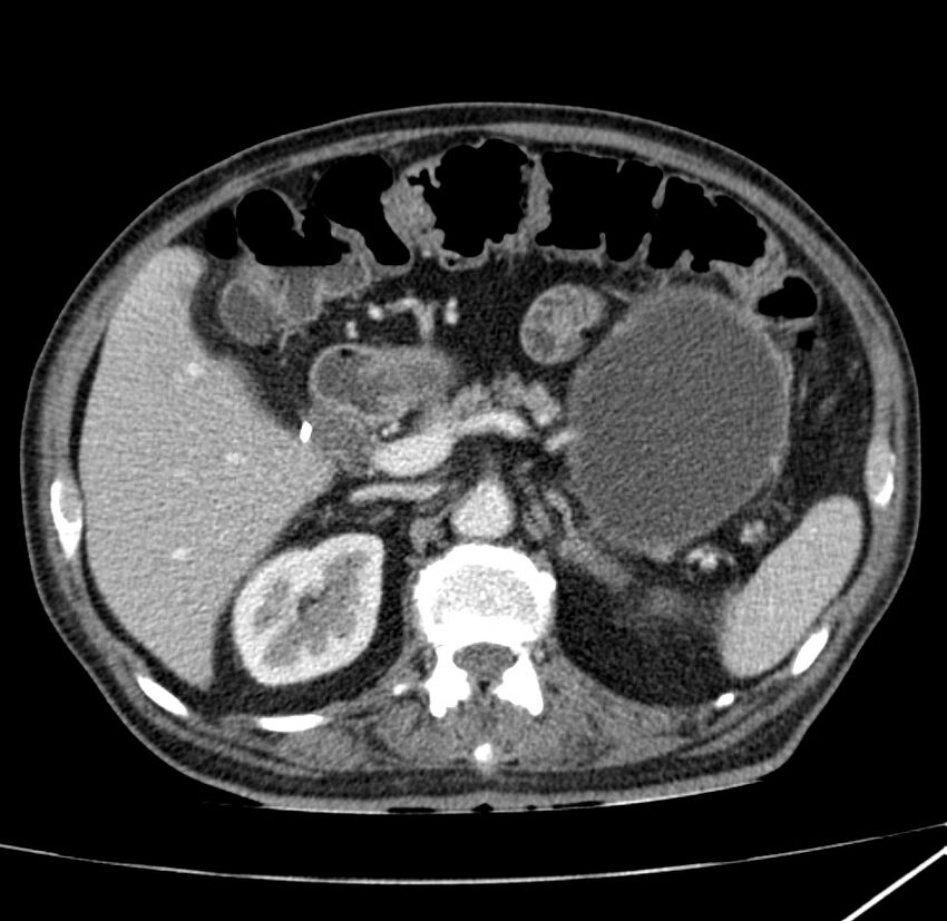 Adenocarcinoma of colon with entero-colic fistula (Radiopaedia 22832-22852 Axial C+ portal venous phase 25).jpg
