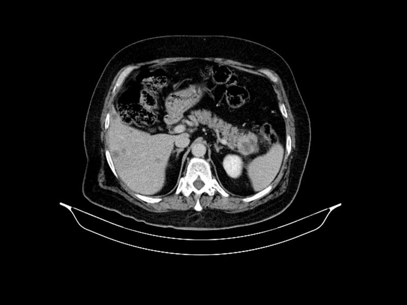 File:Adenocarcinoma of pancreas with hepatic metastasis (Radiopaedia 64332-73122 Axial C+ delayed 31).jpg
