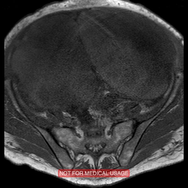 File:Adenocarcinoma of the cervix (Radiopaedia 28373-28615 Axial T1 22).jpg