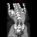 Adenocarcinoma of the colon (Radiopaedia 8191-9039 Coronal liver window 39).jpg
