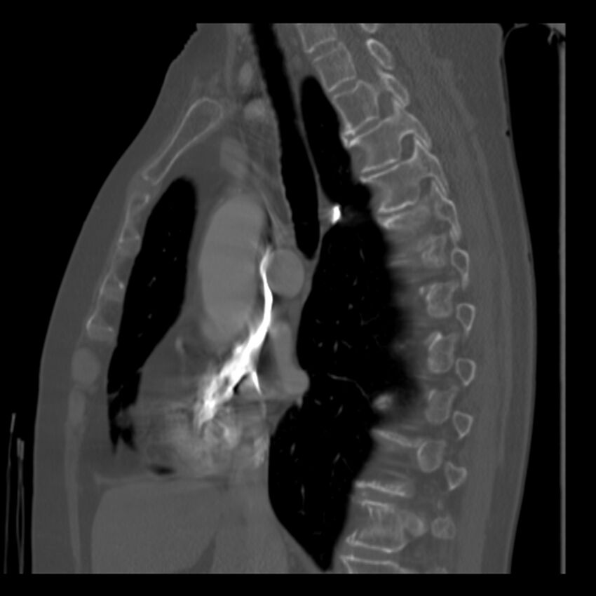Adenocarcinoma of the lung (Radiopaedia 41015-43755 Sagittal bone window 48).jpg