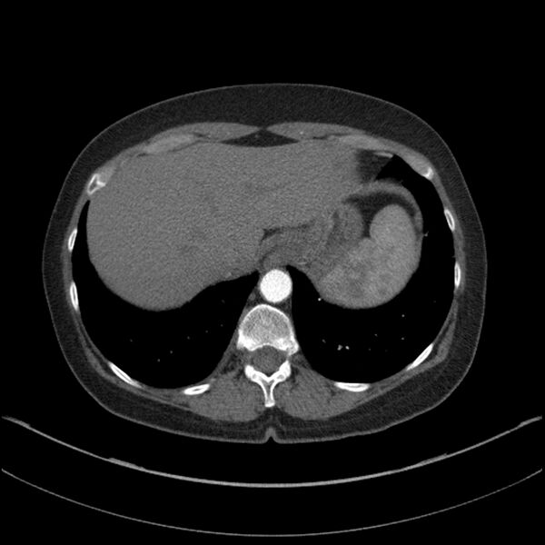 File:Adenocarcinoma of the lung (Radiopaedia 44205-47803 Axial C+ portal venous phase 72).jpg
