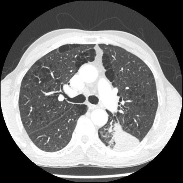 File:Adenocarcinoma of the lung - micropapillary predominant (Radiopaedia 42446-45563 C 22).jpg