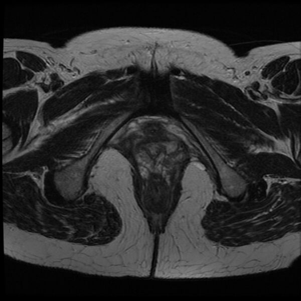 File:Adenoma malignum of the cervix (Radiopaedia 24460-24765 C 28).jpg