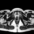 Adenomyoma of the uterus (huge) (Radiopaedia 9870-10438 Axial T2 5).jpg