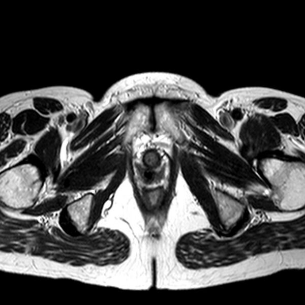 File:Adenomyoma of the uterus (huge) (Radiopaedia 9870-10438 Axial T2 5).jpg