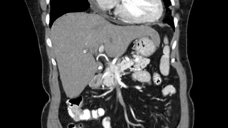 File:Adenomyomatosis of the gallbladder (Radiopaedia 12142-12483 Coronal C+ arterial phase 16).jpg