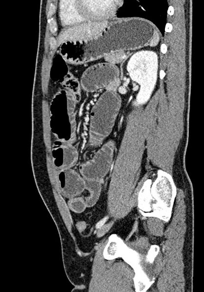 File:Adhesional small bowel obstruction (Radiopaedia 58900-66131 Sagittal C+ portal venous phase 163).jpg
