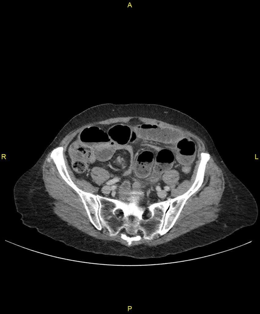 Adhesional small bowel obstruction (Radiopaedia 85402-101024 Axial C+ portal venous phase 210).jpg