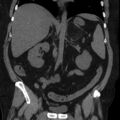 Adrenal myelolipoma (Radiopaedia 8216-9068 non-contrast 6).jpg