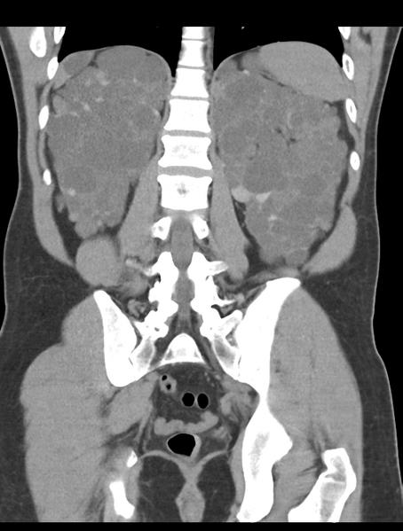 File:Adult polycystic kidney disease (Radiopaedia 47866-52626 Coronal non-contrast 36).png