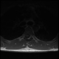 Aggressive vertebral hemangioma (Radiopaedia 39937-42404 Axial T1 28).png