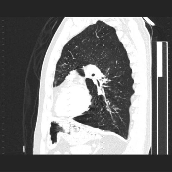 File:Allergic bronchopulmonary aspergillosis (Radiopaedia 21386-21320 Sagittal lung window 7).jpg