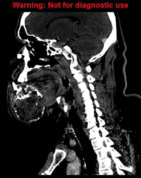 File:Ameloblastoma (Radiopaedia 33126-34164 F 41).jpg