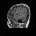 Amnestic syndrome secondary to hypoxic brain injury (Radiopaedia 24743-25004 T1 17).jpg