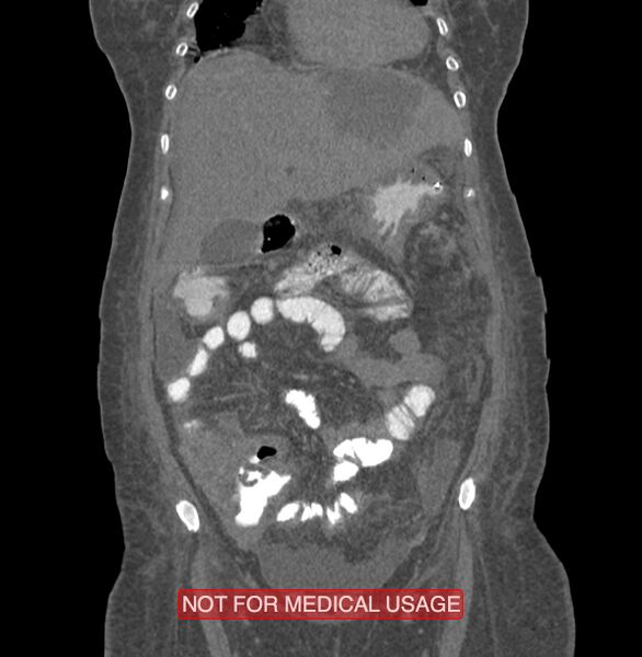 File:Amoebic enterocolitis with liver abscess (Radiopaedia 35100-36609 B 49).jpg