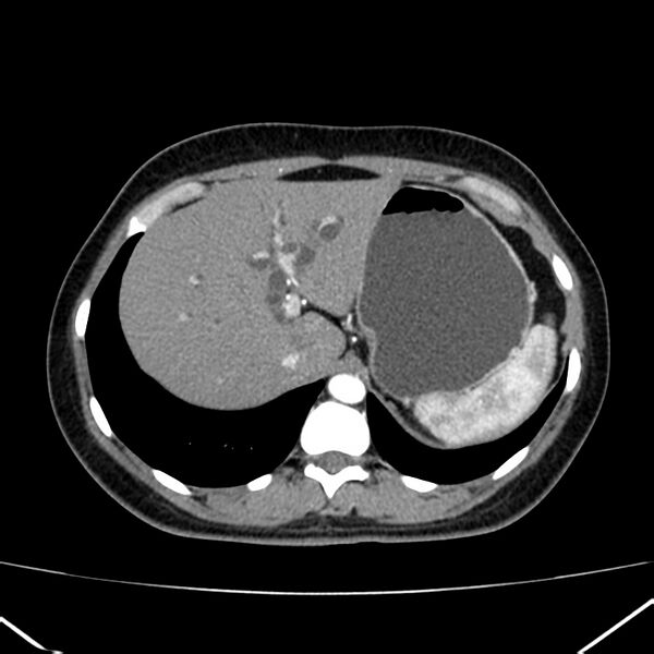 File:Ampullary tumor (Radiopaedia 22787-22816 B 18).jpg