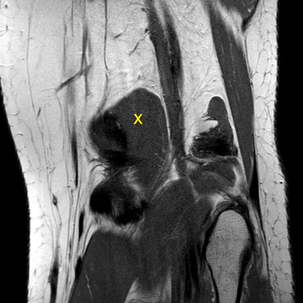 File:Anatomy Quiz (MRI knee) (Radiopaedia 43478-46874 A 25).jpeg