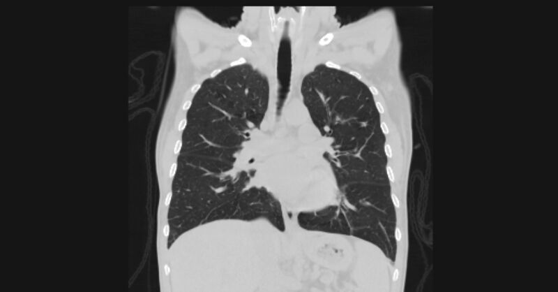 File:Angioinvasive aspergellosis (Radiopaedia 66995-76315 Coronal lung window 31).jpg