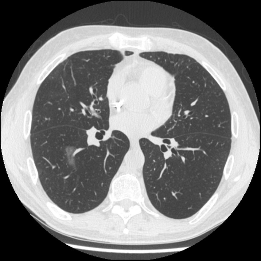 Angioinvasive aspergillosis (Radiopaedia 43957-47466 Axial lung window 38).jpg