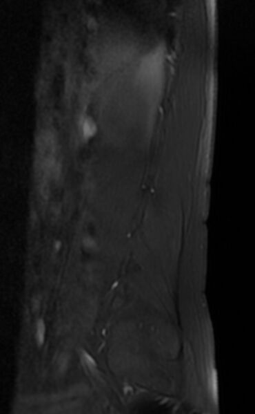 File:Ankylosing spondylitis - Andersson lesion (Radiopaedia 81878-95838 Sagittal T1 fat sat 1).jpg
