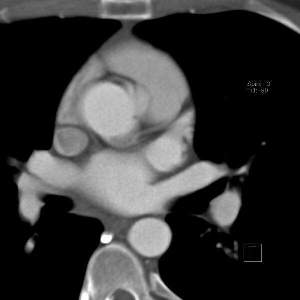 File:Anomalous right coronary artery (ARCA) with interarterial course (Radiopaedia 12423-12677 B 3).jpg