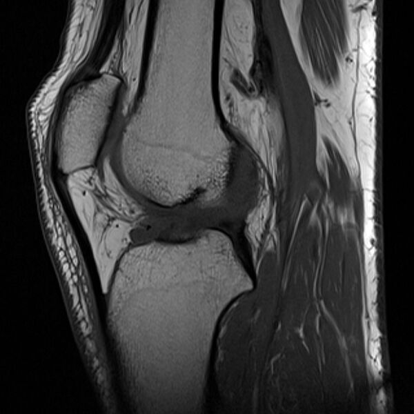 File:Anterior cruciate ligament tear - ramp lesion (Radiopaedia 71883-82322 Sagittal T1 12).jpg
