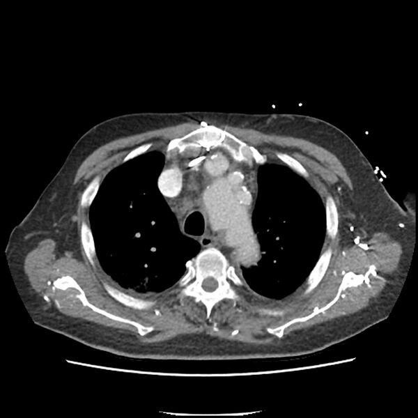 File:Aortic arch graft infection (FDG PET-CT) (Radiopaedia 71975-82437 A 12).jpg