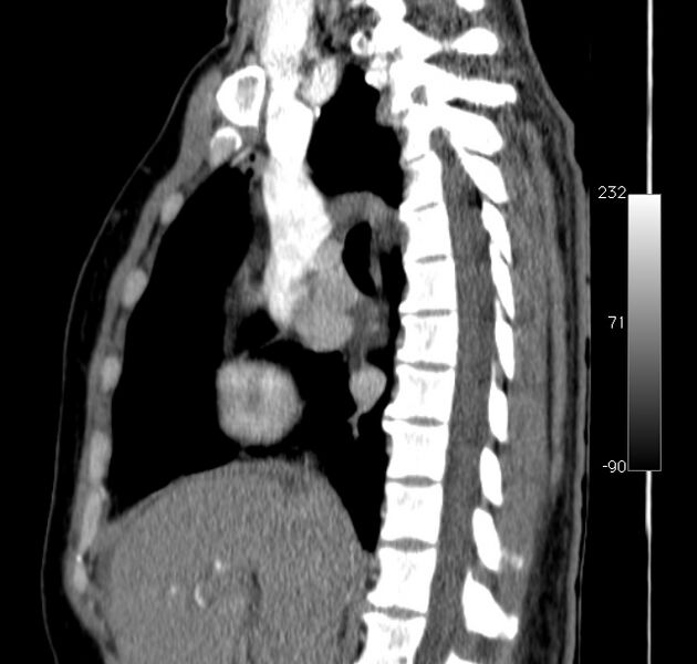 File:Aortic dissection - Stanford type A (Radiopaedia 29247-29659 C 35).jpg
