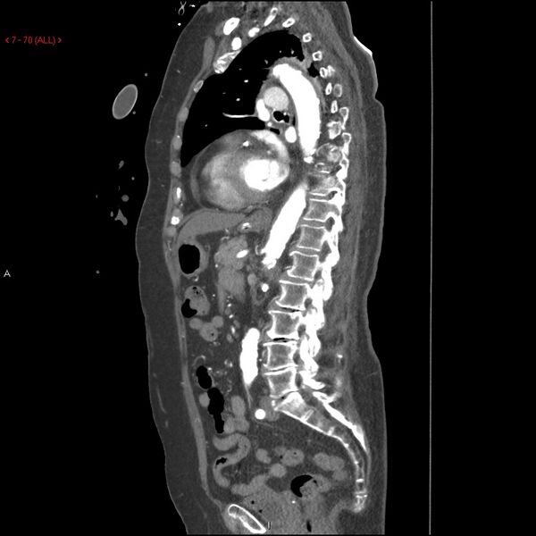 File:Aortic intramural hematoma (Radiopaedia 27746-28001 C 39).jpg