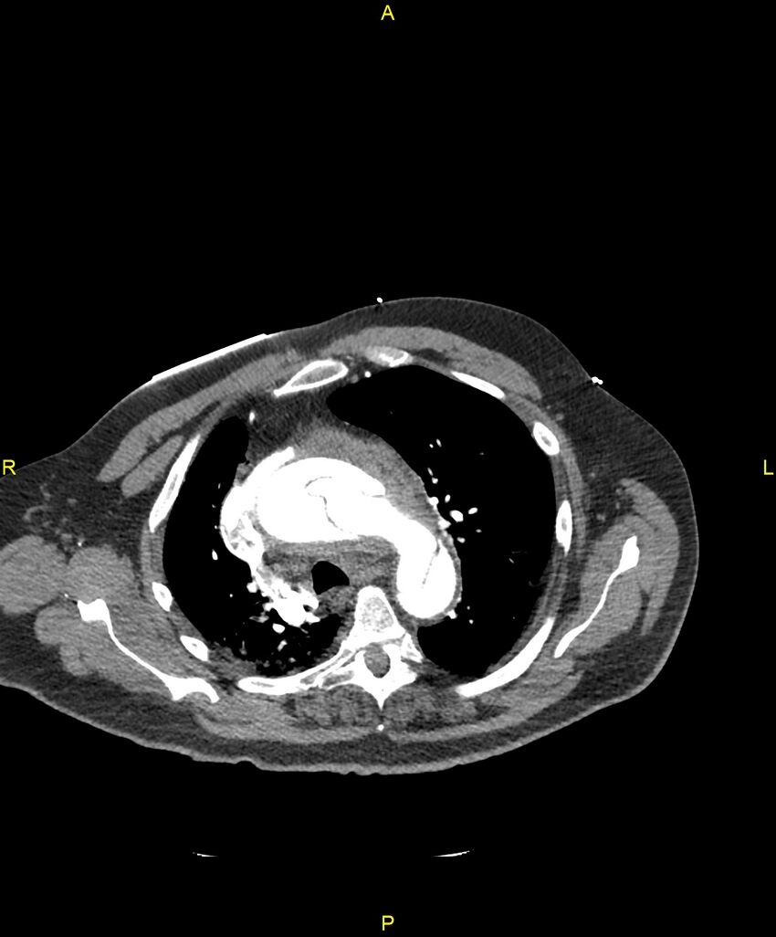 Aortic rupture (Radiopaedia 88822-105594 B 76).jpg
