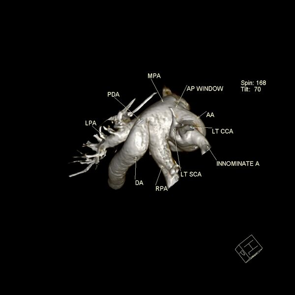 File:Aortopulmonary window, interrupted aortic arch and large PDA giving the descending aorta (Radiopaedia 35573-37077 3D 5).jpg