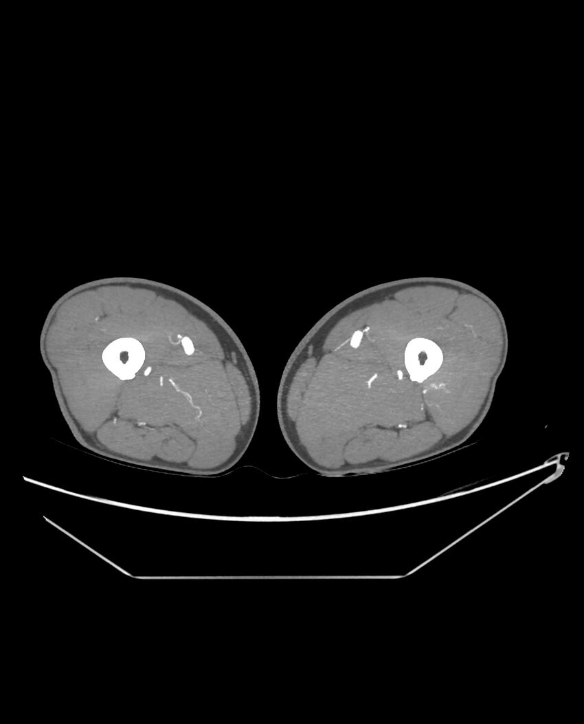 Aplastic posterior tibial arteries (Radiopaedia 84021-99249 A 137).jpg