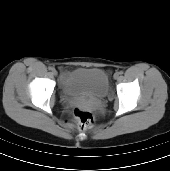 File:Appendicitis and incidental bicornuate uterus (Radiopaedia 22833-22853 Axial non-contrast 43).jpg