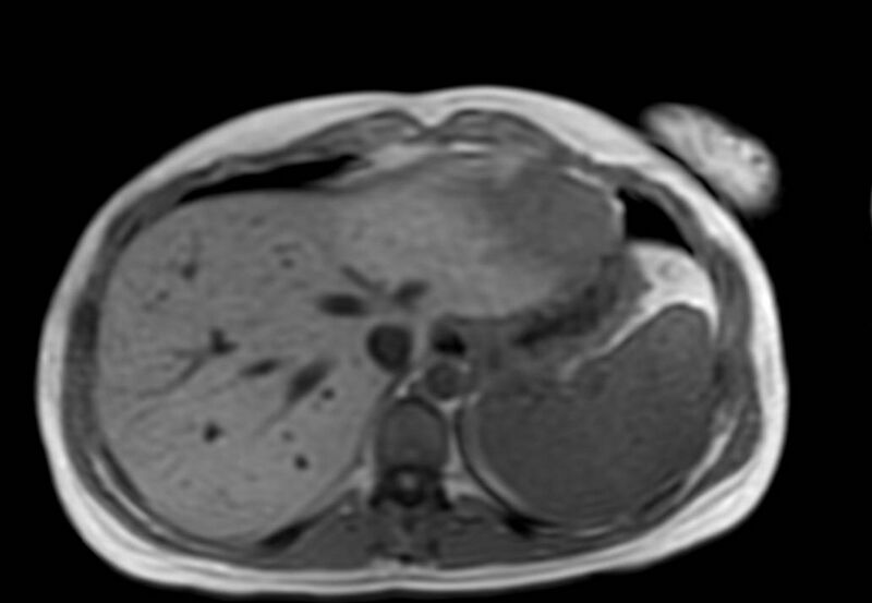 File:Appendicitis in gravida (MRI) (Radiopaedia 89433-106395 Axial T1 in-phase 5).jpg