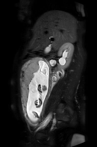 File:Appendicitis in gravida (MRI) (Radiopaedia 89433-106395 Sagittal T2 SPAIR 41).jpg