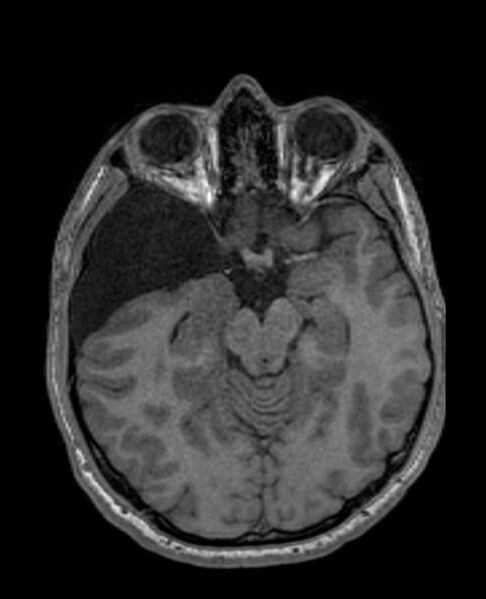 File:Arachnoid cyst- extremely large (Radiopaedia 68741-78451 Axial T1 31).jpg