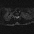 Arachnoid cyst - spinal (Radiopaedia 66835-76157 Axial T2 3).jpg