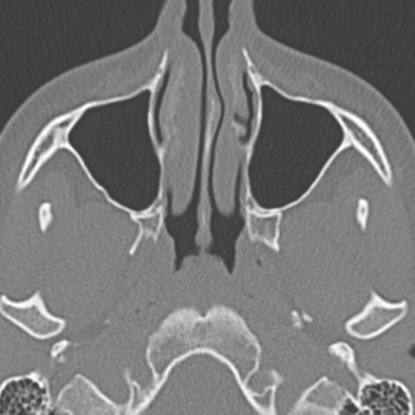 File:Arrested pneumatization of the sphenoid (Radiopaedia 10700-11172 Axial non-contrast 13).jpg