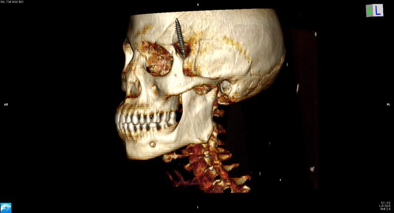 File:Arrow injury to the head (Radiopaedia 75266-86388 3D horizontal 14).jpg