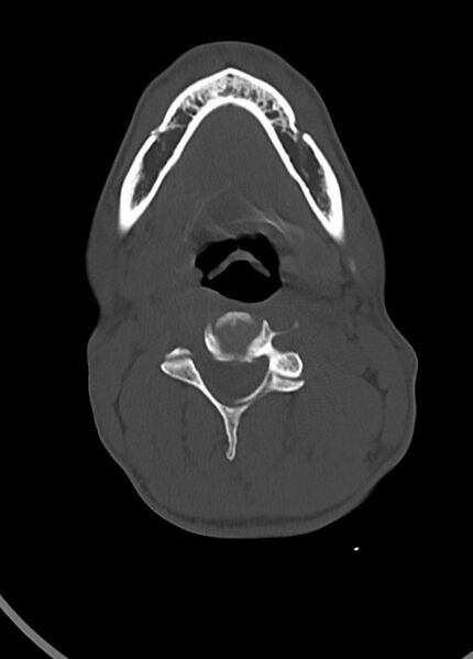 File:Arrow injury to the head (Radiopaedia 75266-86388 Axial bone window 16).jpg