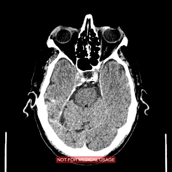 File:Artery of Percheron infarction (Radiopaedia 28679-28967 Axial non-contrast 39).jpg