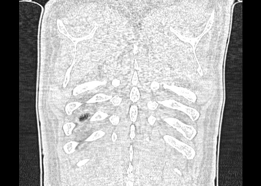 Asbestos pleural placques (Radiopaedia 57905-64872 Coronal lung window 281).jpg